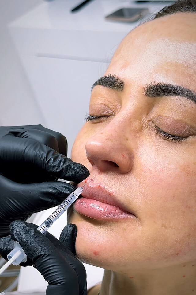 Dermal Fillers