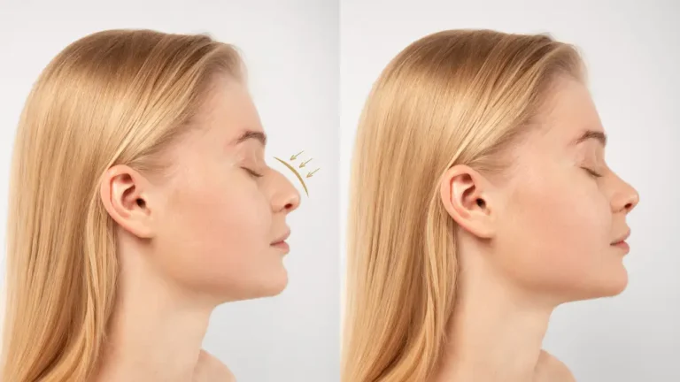 Nose Fillers Before and After