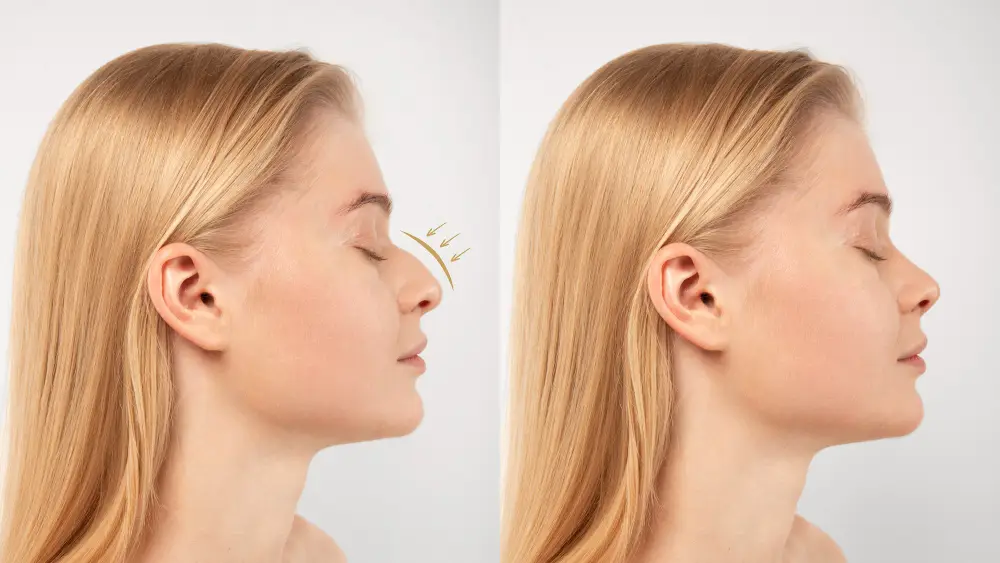 Nose Fillers Before and After